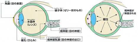 緑内障