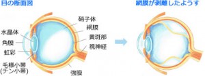 糖尿病網膜症